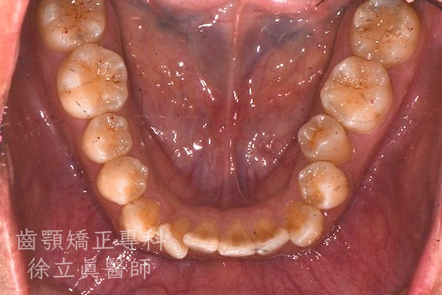 案例一・下顎・治療前