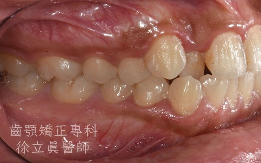 案例一・側面一・治療前