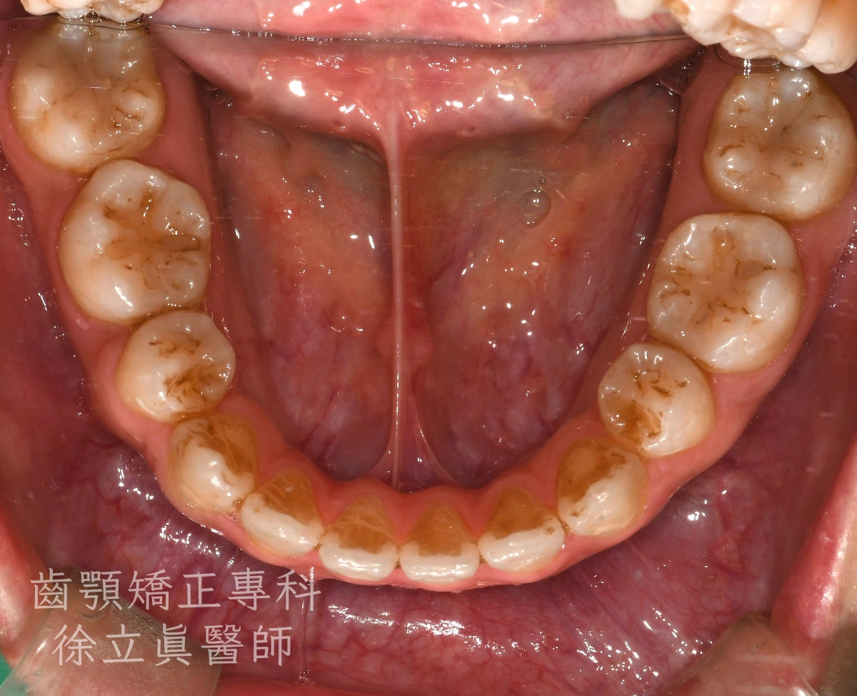 案例二・下顎・治療後