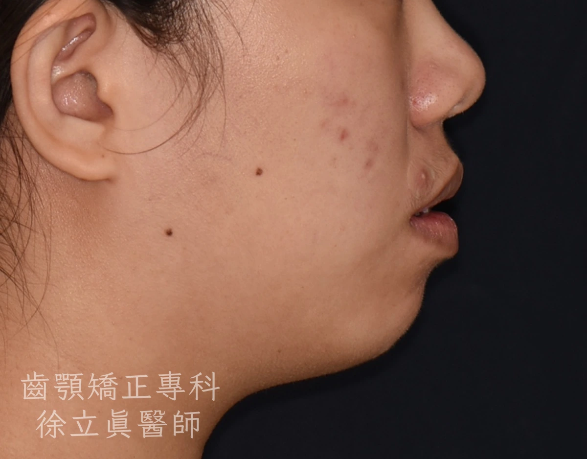案例二・側貌・治療前