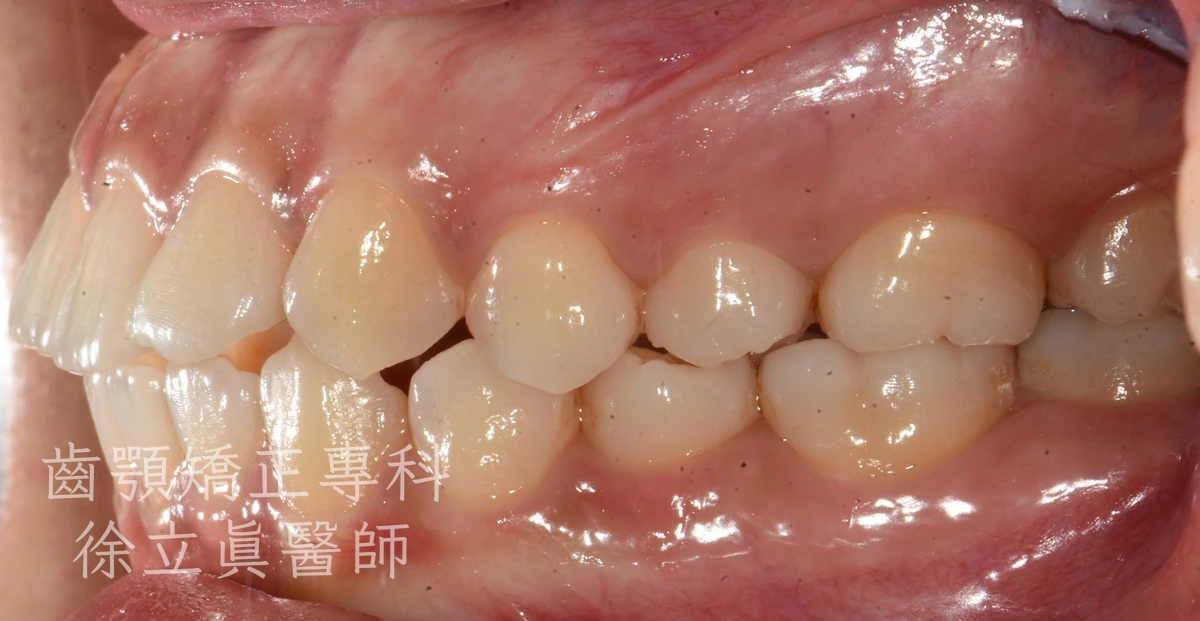 案例二・側面二・治療前