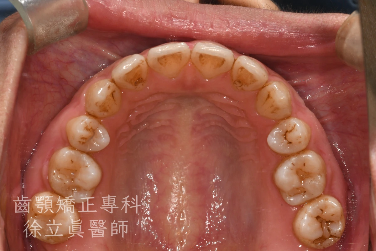 案例二・上顎・治療後