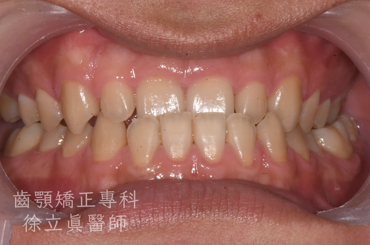 案例三・正面・治療前