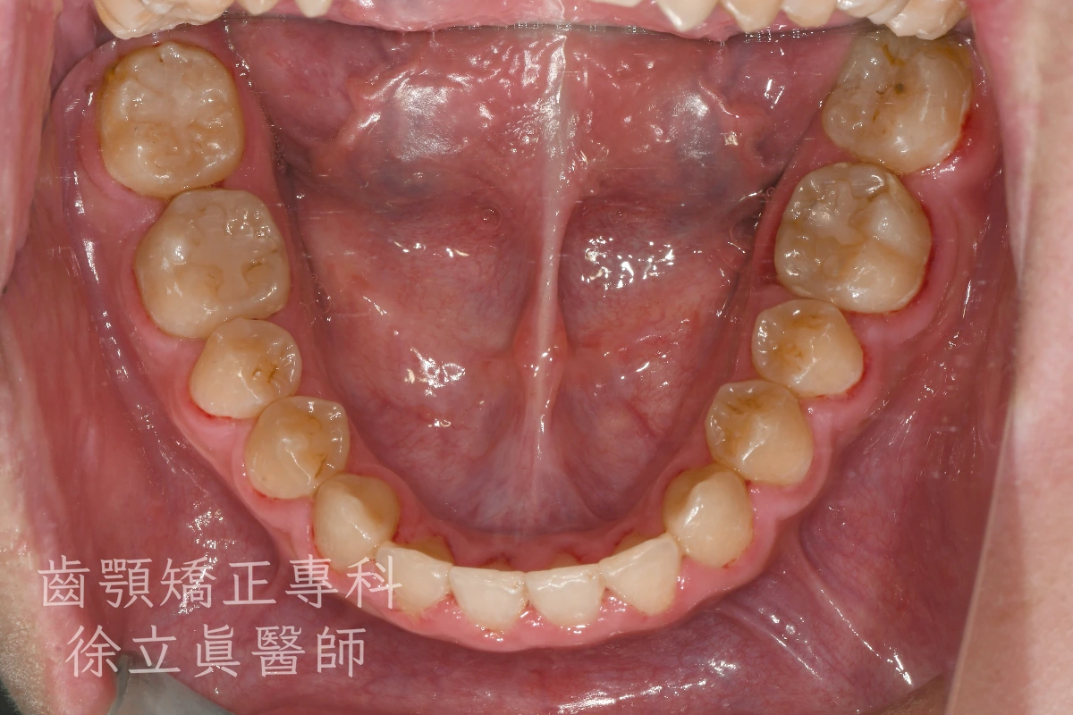 案例三・下顎・治療後