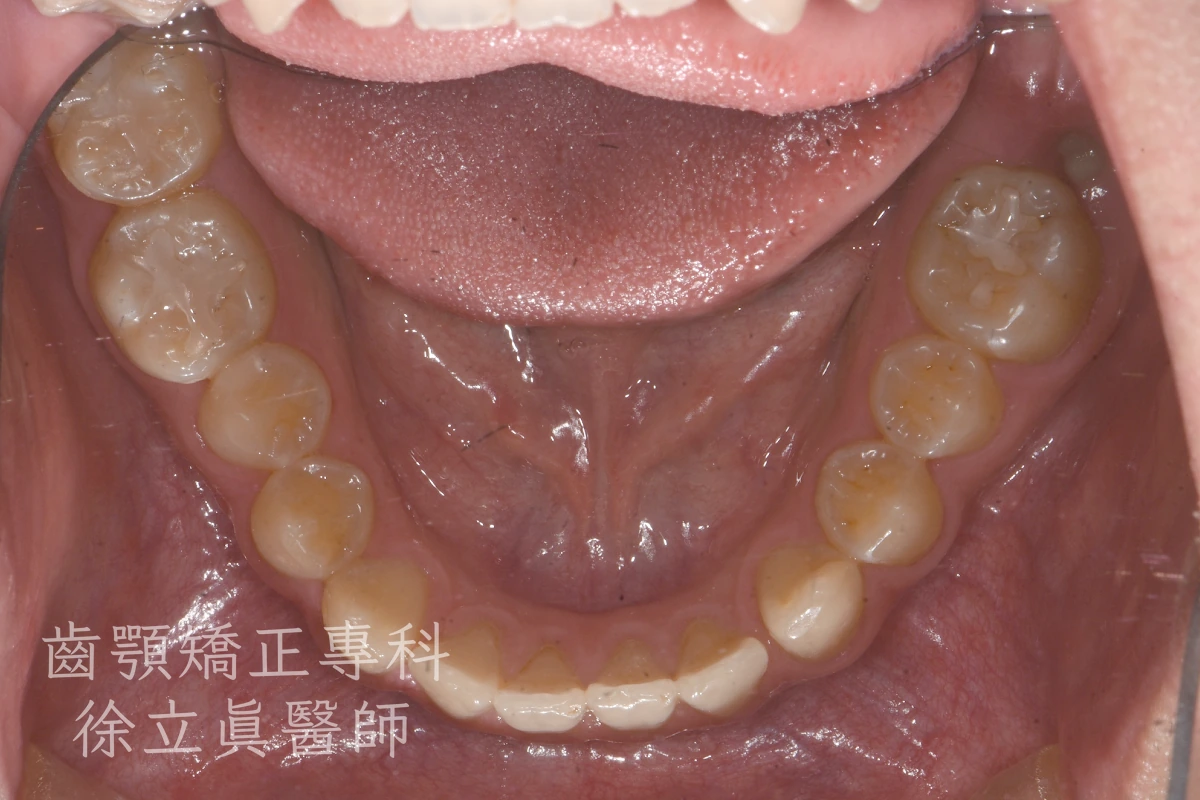 案例三・下顎・治療前