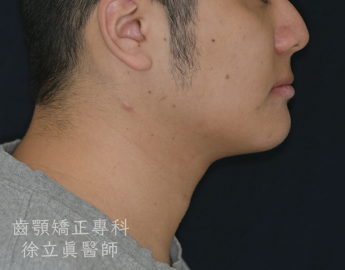 案例三・側貌・治療後