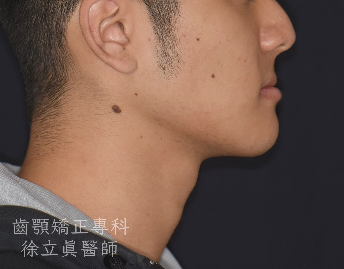 案例三・側貌・治療前