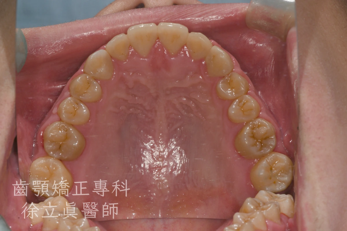 案例三・上顎・治療後