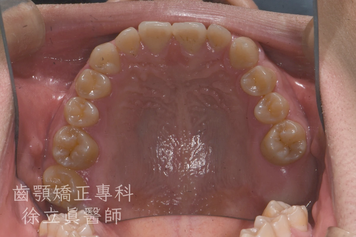 案例三・上顎・治療前
